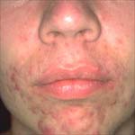 Acne Treatments Irvine Orange County CA