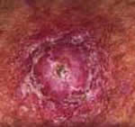 Squamous Cell Carcinoma