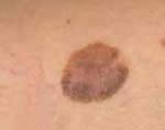 Early Superficial Spreading Melanoma