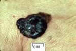 Nodular Melanoma