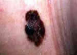 Skin Cancer Treatment CA