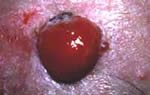 Amelanotic Malignant Melanoma