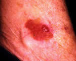 Squamous Cell Carcinoma Bowen's Disease