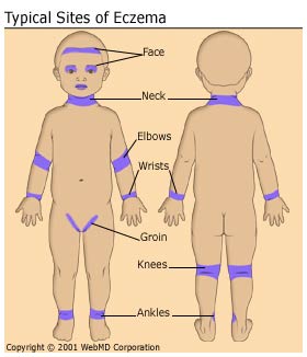 Steroid induced skin rash