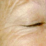 Fine Lines/Wrinkles Treatment Irvine Orange County CA