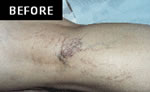 Spider & Vericose Veins Before