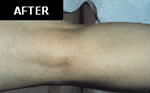 Spider & Vericose Veins After