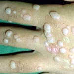 Discoloration of skin around anus