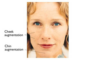 Restylane - Cheek, Chin Augmentation