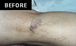 Sclerotherapy